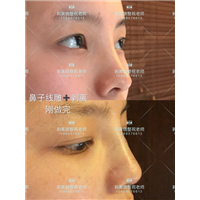 北京剥离微雕|北京剥离微整