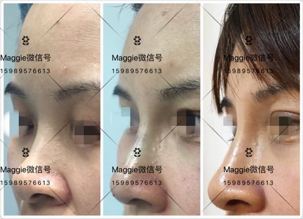 北京哪家医院有剥离印第安纹