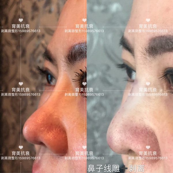 印第安纹剥离微整医院