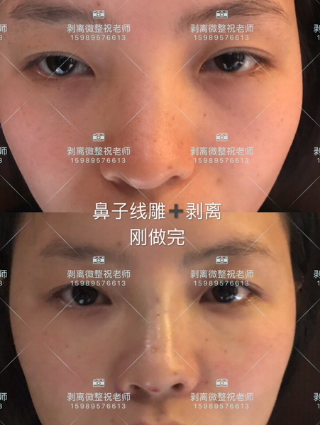 北京剥离微整|剥离微整北京能做吗