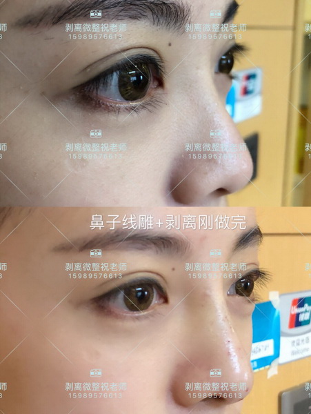 北京剥离微整|剥离微整北京能做吗