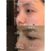 北京剥离微雕|北京剥离微整