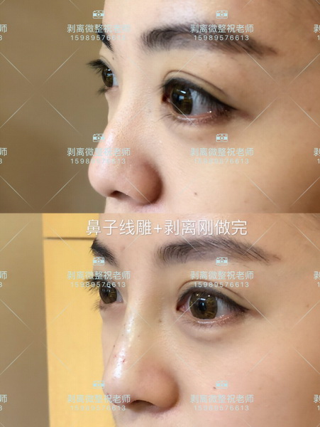 北京剥离微整|剥离微整北京能做吗