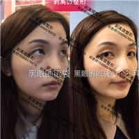 印第安纹剥离微整