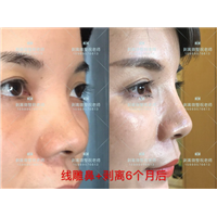 北京剥离微雕|北京剥离微整