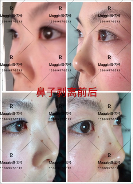 北京哪家医院有剥离印第安纹