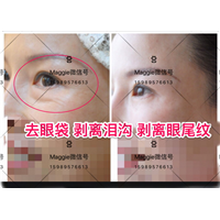 印第安纹剥离微整