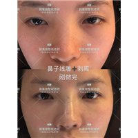 北京剥离微整|剥离微整北京能做吗