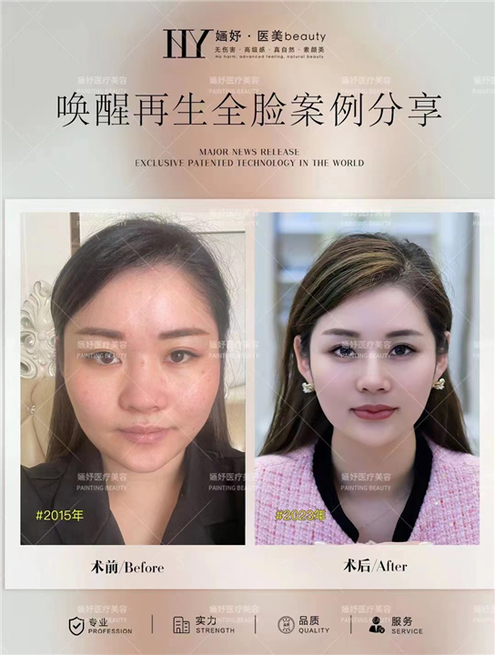 北京剥离唤醒再生术