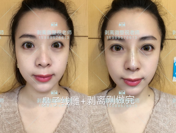 北京剥离微整|剥离微整北京能做吗