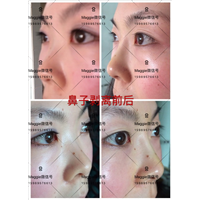 北京哪家医院有剥离印第安纹