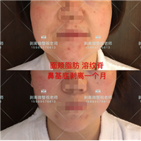 北京剥离微整