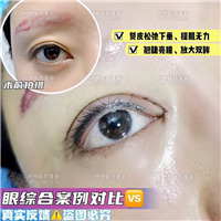 妤悦整形眼综合