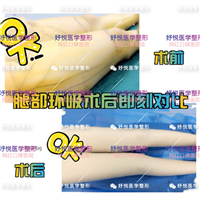 妤悦整形吸脂瘦身
