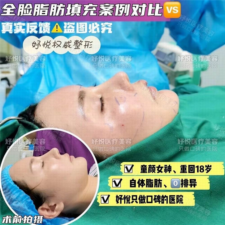 妤悦整形鼻综合