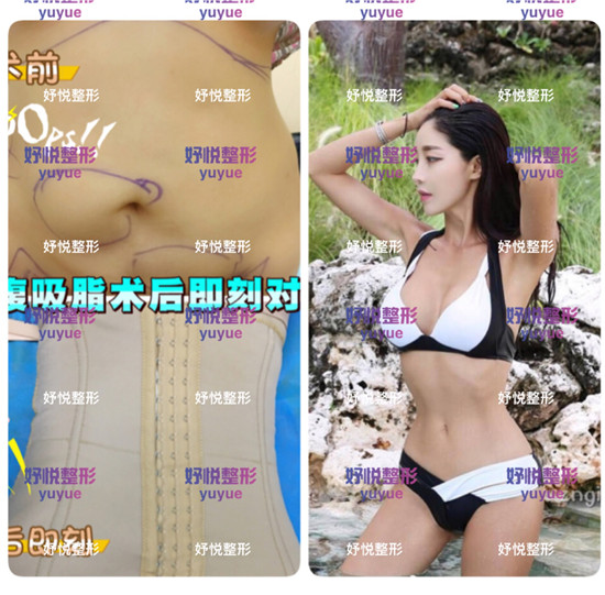 妤悦整形吸脂瘦身
