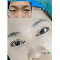 妤悦整形眼综合