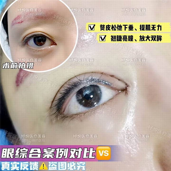妤悦整形眼综合