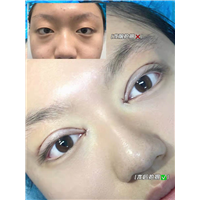妤悦整形眼综合