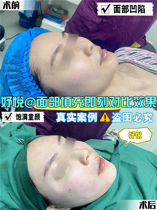 妤悦整形眼综合