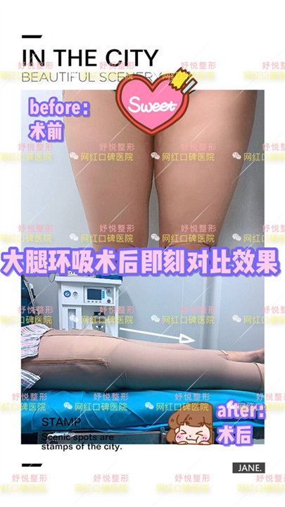 妤悦整形吸脂瘦身