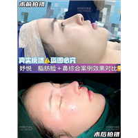 妤悦整形鼻综合