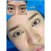 妤悦整形眼综合