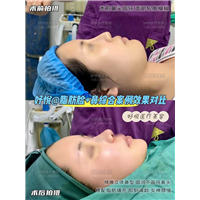 妤悦整形鼻综合
