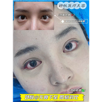 妤悦整形眼综合