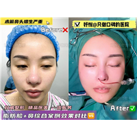 妤悦整形鼻综合