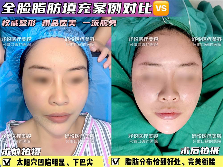 妤悦整形鼻综合