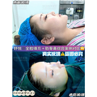 妤悦整形鼻综合