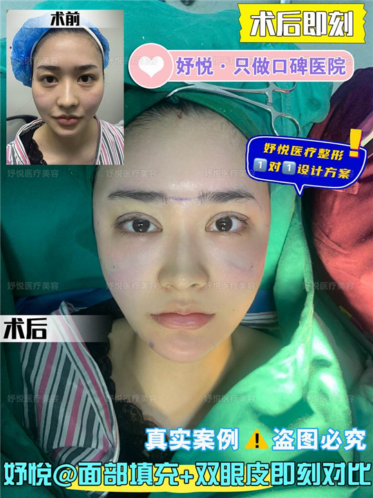 妤悦整形鼻综合