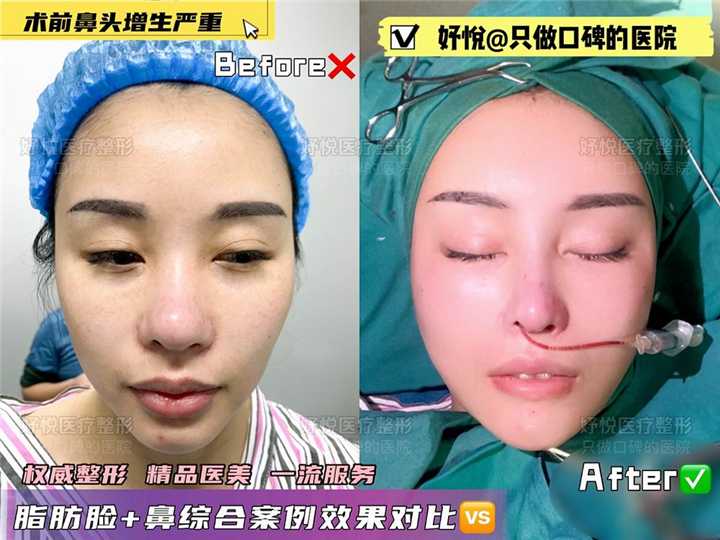 妤悦整形鼻综合