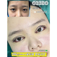 妤悦整形眼综合