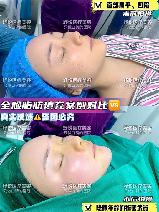 妤悦整形鼻综合