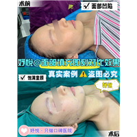 妤悦整形眼综合