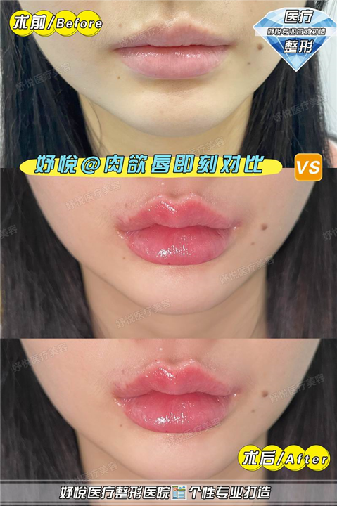 妤悦整形鼻综合