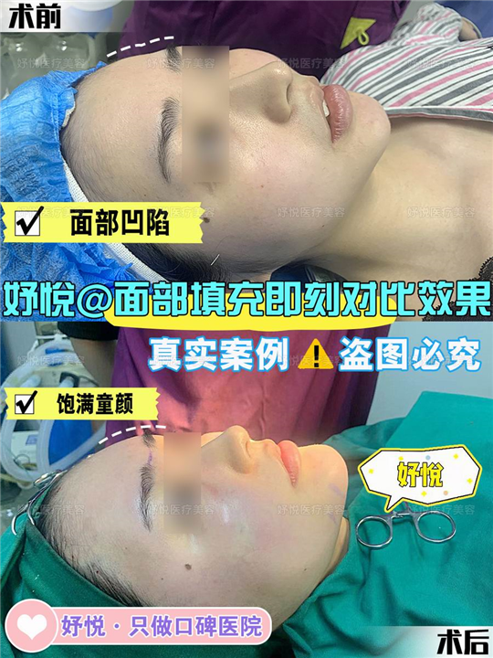 妤悦整形鼻综合