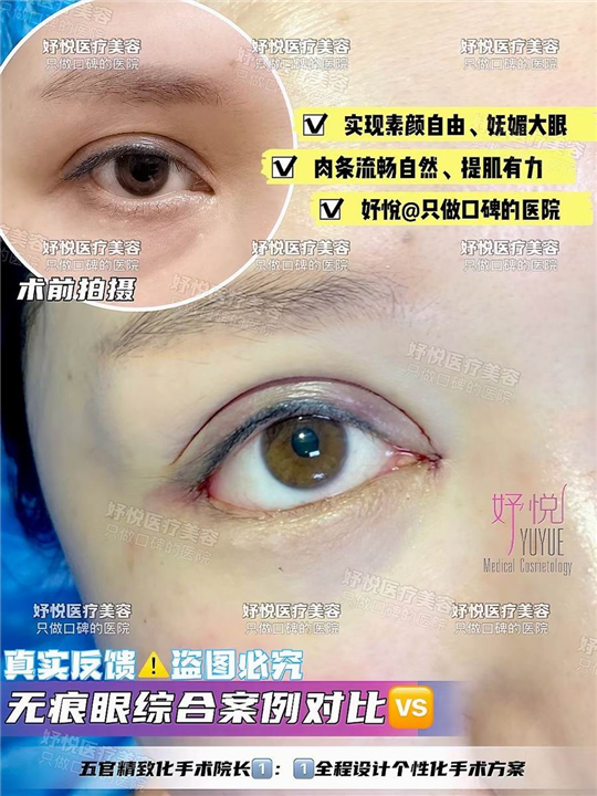 妤悦整形眼综合