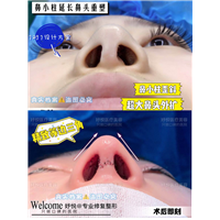 妤悦整形眼综合