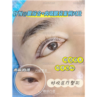 妤悦整形眼综合