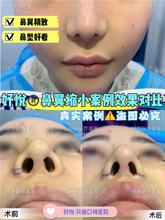 妤悦整形眼综合