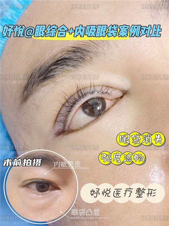 妤悦整形眼综合