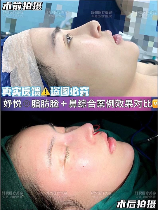 妤悦整形鼻综合