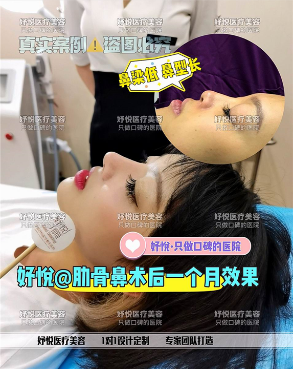 妤悦整形眼综合