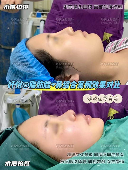 妤悦整形鼻综合