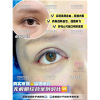妤悦整形眼综合