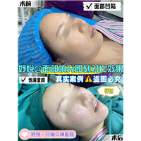 妤悦整形眼综合