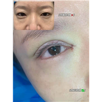 妤悦整形眼综合